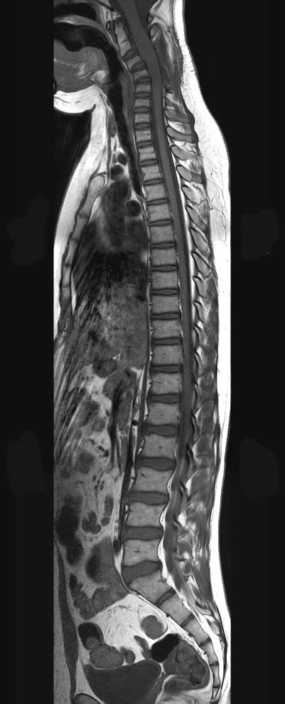 Total Spine On A 14 Year Old Patient Philips Mr Body Map