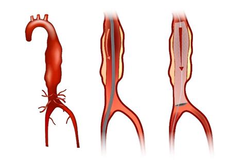 Tema Cirug A Endovascular