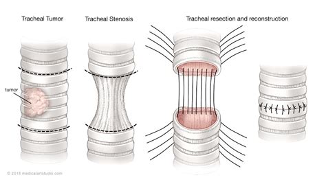 Diseases of the Trachea and Airway | Department of Cardiothoracic Surgery | Stanford Medicine