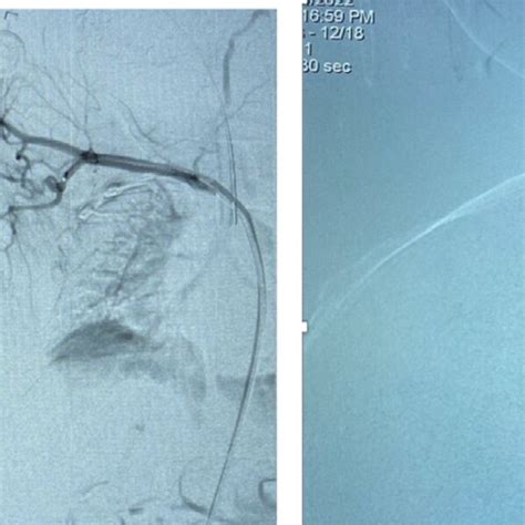 A Pre Embolization And B Post Second Embolization On Right Download Scientific Diagram