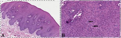 Focal Epithelial Hyperplasia Hecks Disease In Two Chinese Females