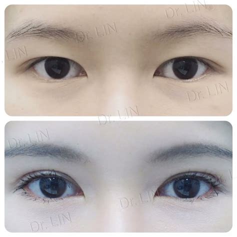 Current Methods Of Double Eyelid Surgery Pros And Cons Inz Clinic