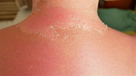 These Sunburn Horror Stories Will Remind You That Spf Is A Blessing