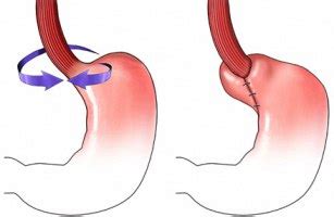 Hiatus Hernia Info: Slipping Hiatus Hernia Symptoms