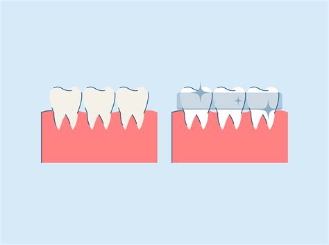 How Long Do Teeth Whitening Strips Take to Work? | SNOW® Oral Care