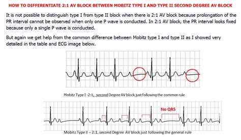 How To Differentiate 21 Av Block Between Mobitz Type I And Type Ii