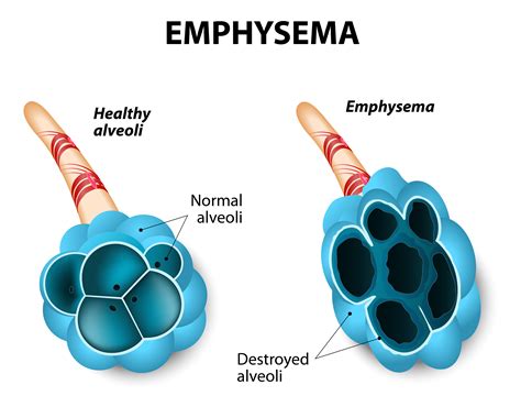 Patients with Alpha-1 Antitrypsin Deficiency (AATD) Show Positive ...