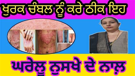 ਖੁਰਕ ਚੰਬਲ ਨੂੰ ਕਰੇ ਠੀਕ Aayurvedic Treatment And Gharelu Nukshe For Free