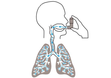 Why Optimise Inhaler Technique in Asthma and COPD? - Issues and Answers