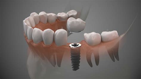 Placing Dental Implants Difference Between A Periodontist And An Oral