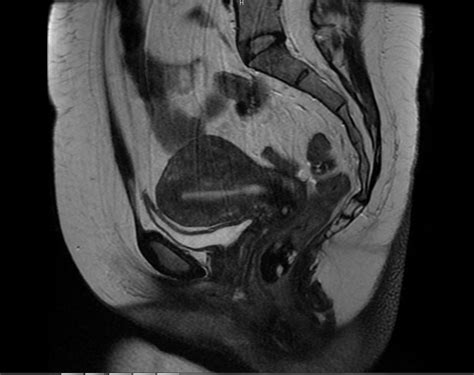 Mr Pelvis With And Without Iv Contrast Greater Waterbury Imaging Center