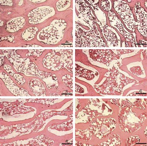 Effect Of Zoledronic Acid And Propranolol Alone Or In Combination On