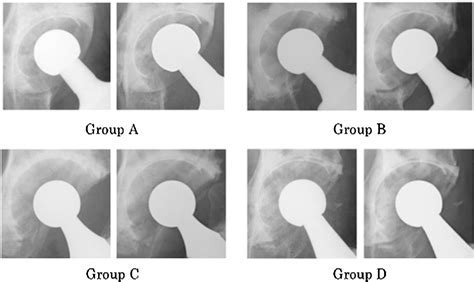 Figure 2 From Polyethylene And Highly Cross Linked Polyethylene For Cemented Total Hip