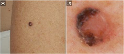 Nodular Melanoma On The Lateral Right Upper Arm Of A 62‐year‐old Woman Download Scientific