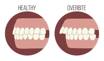 Overbite vs Underbite: What It Is and How To Fix With Mewing ...