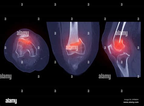 Acquisition CT De L Articulation Du Genou 3D Image De Rendu Montrant