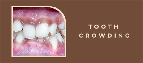 Tooth Crowding Signs Causes And Treatment Of Crowded Teeth