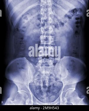 Imagen radiográfica de la columna L S o columna lumbar lateral placas