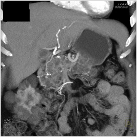 VHL Syndrome with Multiple Renal Carcinoma and Cysts as well as ...