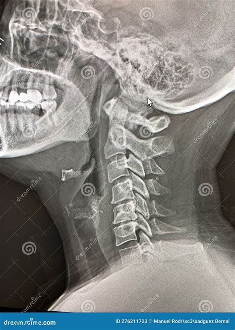 X-ray of a neck stock image. Image of arthritis, surgery - 276211723