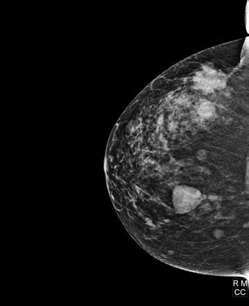 Multifocal Breast Cancer 2D Mammography And Tomosynthesis Radiology