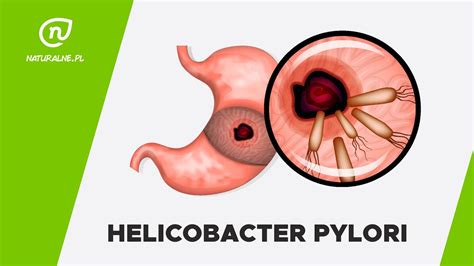 Helicobacter Pylori Przyczyny Objawy Leczenie Lek Med Witold Hot Sex