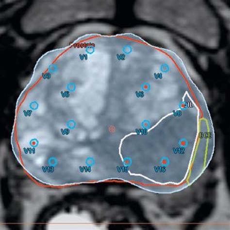 Hdr Brachytherapy Treatment Planning Ct Scan Showing The Prostate