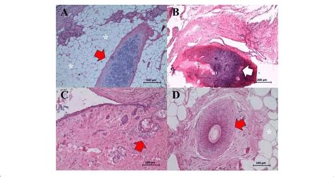 Right Ovary Mature And Well Differentiated Teratoma Showing The