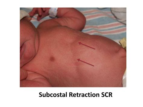 Ppt An Approach To Respiratory Distress In Newborn Powerpoint Presentation Id 2313125