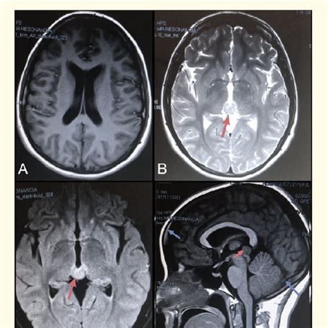 Typical Axial T1 Weighted Magnetic Resonance Image A Axial