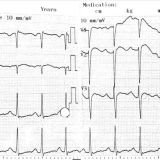 Twelve Lead Electrocardiogram Showing Sinus Rhythm And A Prolonged Qt