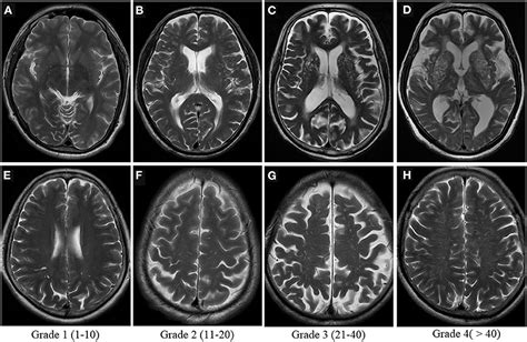 Frontiers Perivascular Spaces Glymphatic System And Mr