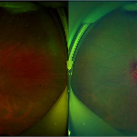 Combined Detection Of Lattice Degeneration Retinal Breaks And Retinal