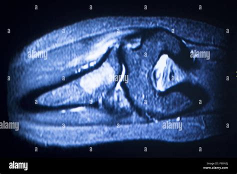 Resonancia Magn Tica Mri Scan Test M Dicos Codo Resultados Mostrando