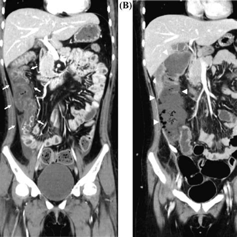 Abdominal Contrast Enhanced Computed Tomography Ct On Days 16 And 27 Download Scientific