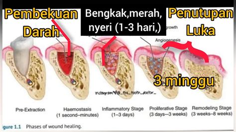 Berapa Lama Penyembuhan Luka Cabut Gigi Operasi Gigi Geraham Bungsu
