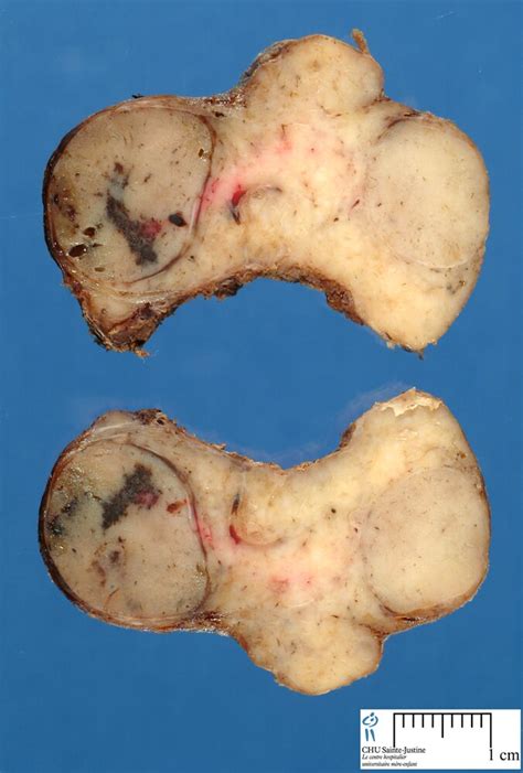 Thyroid Nodular Hyperplasia Humpath Human Pathology Photos