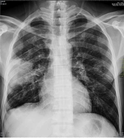 Wedge Shaped Consolidations In Right Lung Middle Zone Could Be