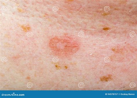 Candida Infection On Human Skin Stock Image Image Of Health Disease