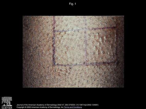 Treatment Of Pseudofolliculitis Barbae In Skin Types Iv V And Vi With