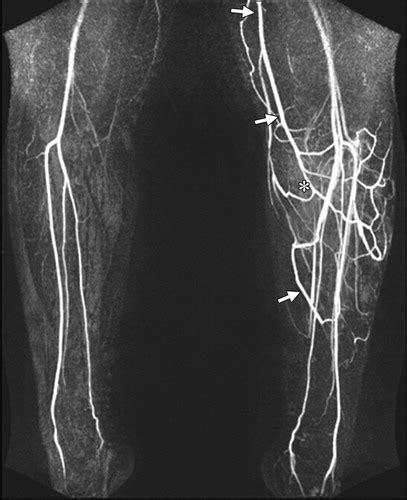 Mr Imaging Of Soft Tissue Vascular Malformations Diagnosis Classification And Therapy Follow