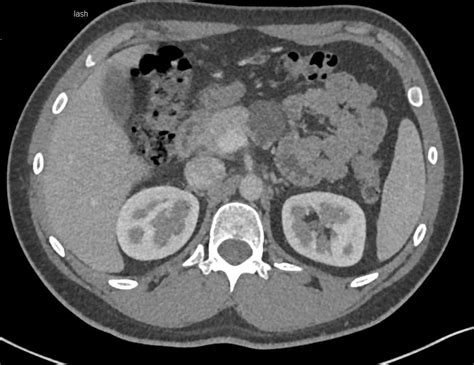 Lymphoepithelial Cyst Of The Body Of The Pancreas Pancreas Case