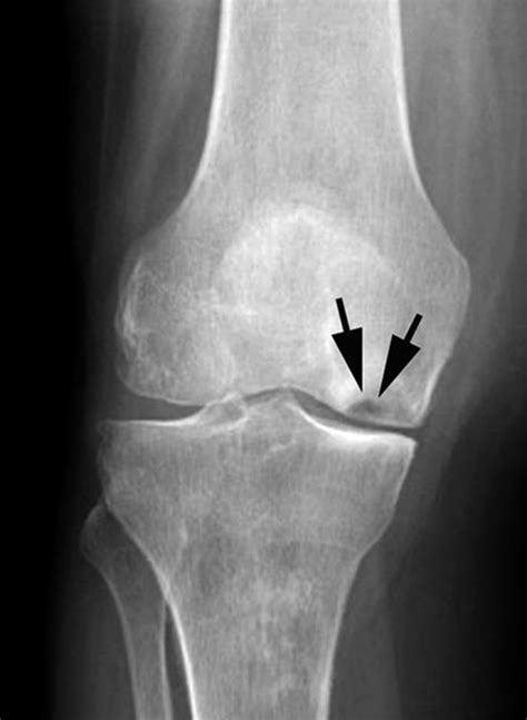 Osteonecrosis Of The Knee