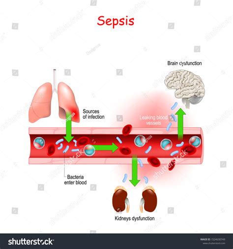 Sepsis Closeup Cross Section Blood Vessel Vector có sẵn miễn phí bản