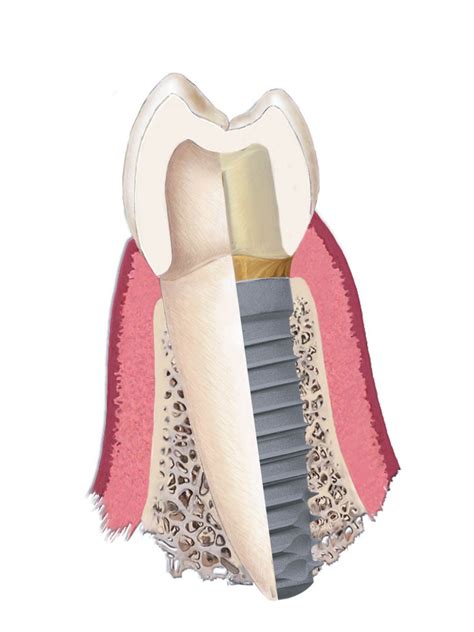 Titanium Implants- Hoffman Estates IL