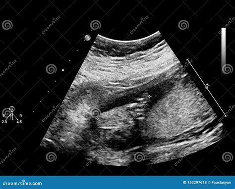 Ultrasound Scherm Met Foetale Echocardiografie Stock Foto Image Of