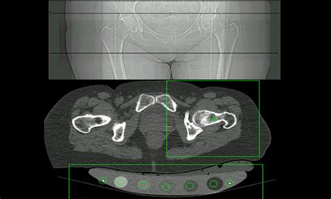 Quantitative Computed Tomography QCT UCSF Radiology