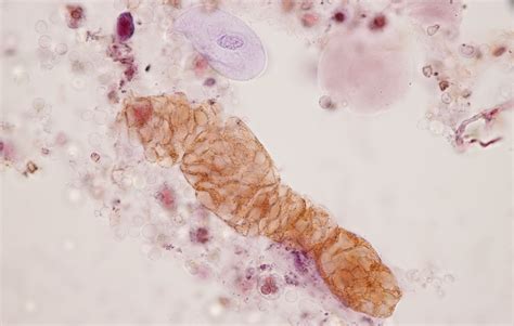 Urine Sediment Of The Month Fibrin Casts In Urine Microscopy Renal