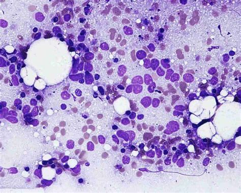 Carcinoma Epidermoide Pulmonar Binipatia E Higienismo Hot Sex Picture