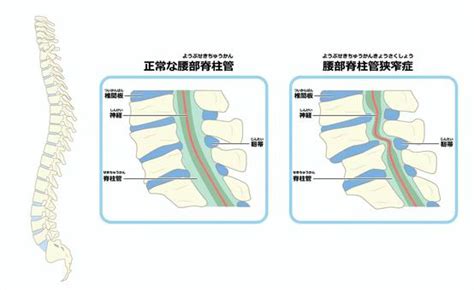 加齢に伴う「脊柱管狭窄症」について 茂原駅前整骨院